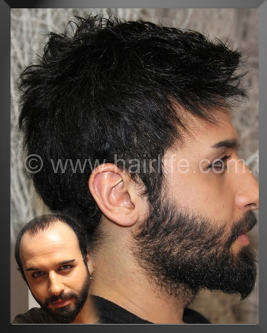 Hairlife Protez Saç — 1